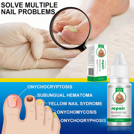 Sway Toenail Fungus Treatment Gel Foot Care Anti Infective Paronychia Onychomycosis - Image 2